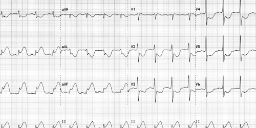 ekg için yüksek tansiyon örneği)